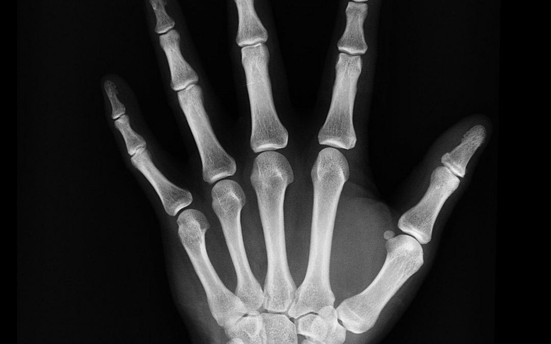 CAH treatment may be linked to lower bone mineral density